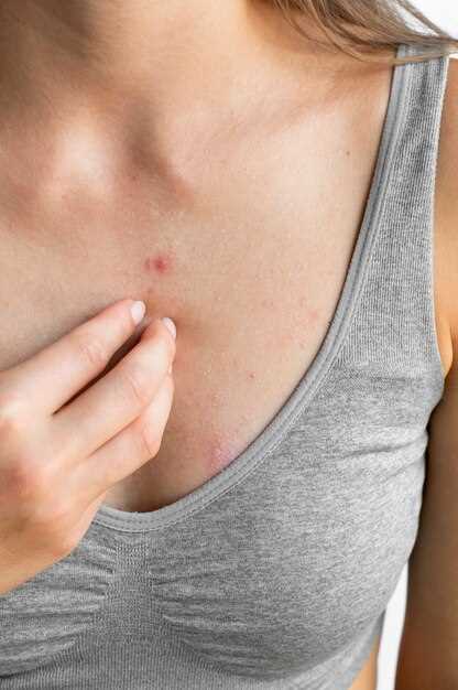Treatment options for hydrochlorothiazide rash