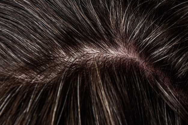 Treatment with Spironolactone